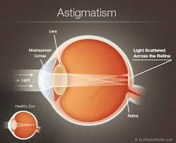 Astigmatism and 2nd Lumbar